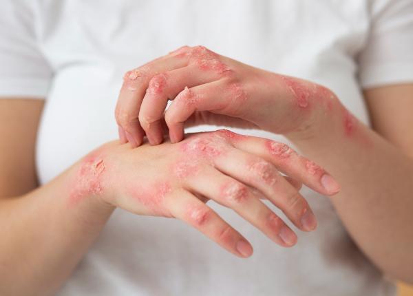 ce alimenteaza de fapt psoriazisul o descoperire neasteptata deschide calea unor tratamente noi