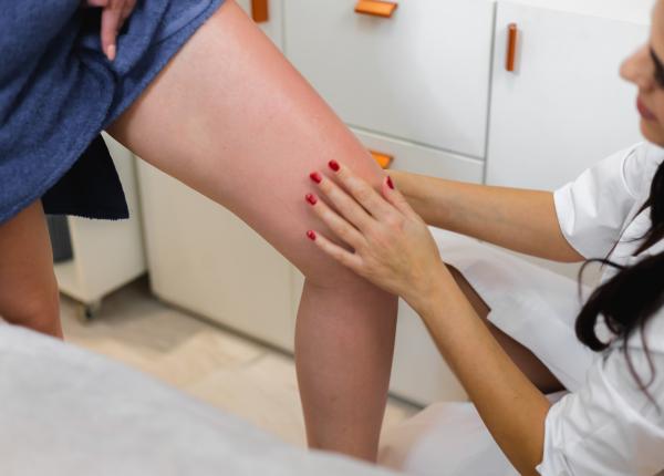 varicele se agraveaza pe canicula trei remedii simple recomandate de chirurgi vasculari