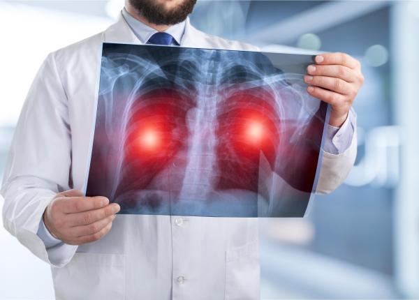 cancerul care ucide cel mai mult in romania testul simplu care poate salva vieti inainte sa apara simptomele cancerului pulmonar