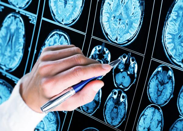 ce au gasit cercetatorii in creierul persoanelor cu alzheimer ar putea schimba tratamentul bolii