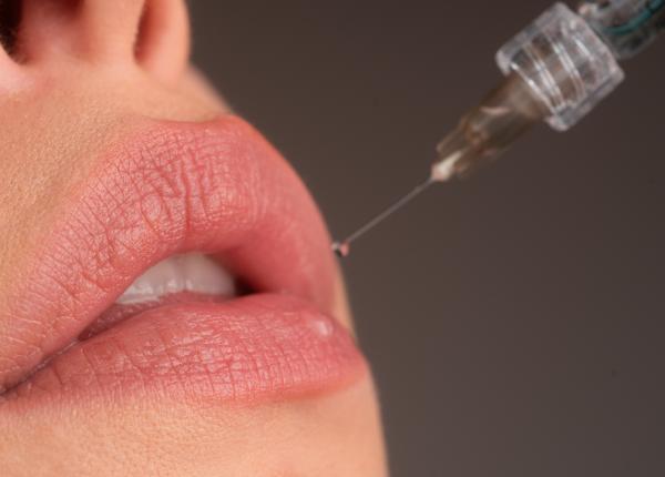 ti ai marit buzele cele 4 greseli care pot strica rezultatul dupa injectarea cu acid hialuronic