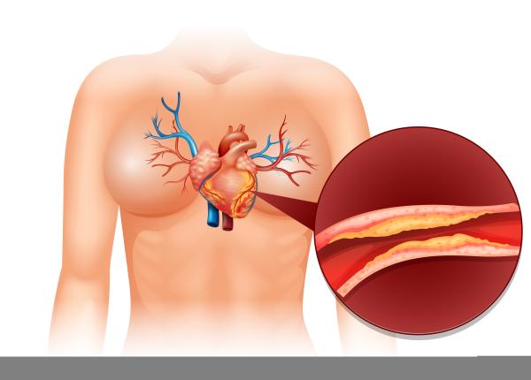tineri de 20 de ani cu artere deja afectate de ce creste riscul cardiovascular