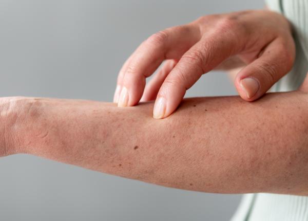 dermatita atopica povara invizibila a unei boli care afecteaza pielea somnul si viata de zi cu zi