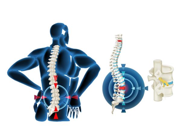 hernia de disc nu trebuie operata intotdeauna cand este necesara interventia explica neurochirurgul stefan suditu