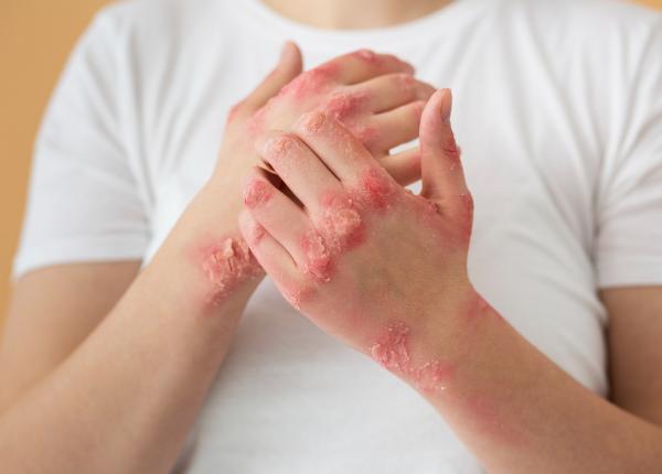 psoriazisul mai complicat decat pare ce s a descoperit in urma noilor cercetari