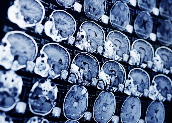 ce au descoperit cercetatorii despre cel mai agresiv cancer cerebral