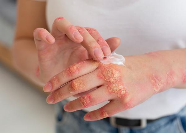 psoriazisul cu pustule care nu afecteaza doar pielea risc mai mare de boli grave si mortalitate