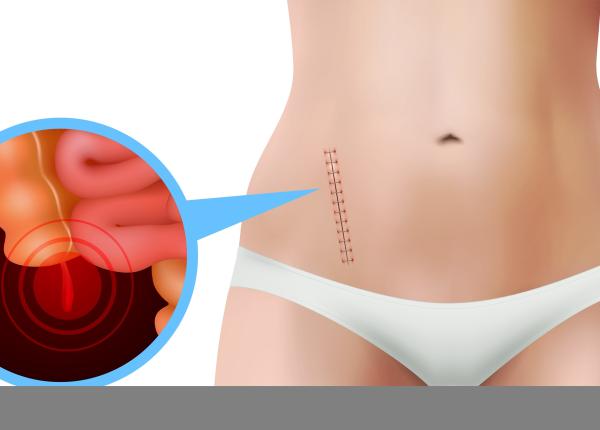 operatia de apendicita este asociata cu un risc de cancer colorectal cu 58 mai mic decat tratamentul
