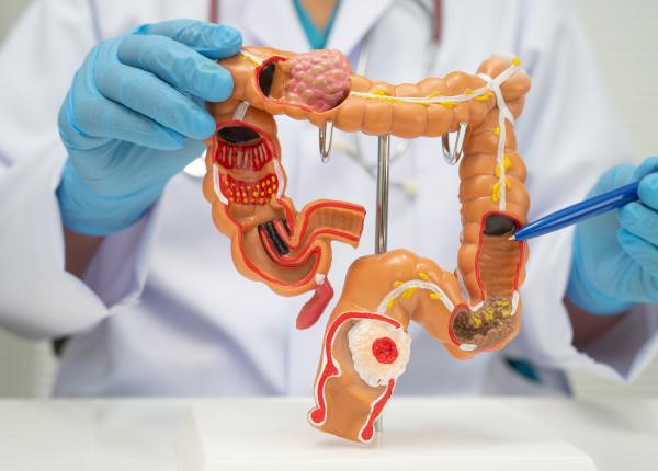 cum reducem riscul de cancer colorectal recomandarile unui medic gastroenterolog