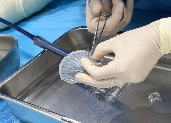 premiera medicala in romania o valva a inimii a fost inlocuita fara operatie pe cord deschis prof univ dr horatiu moldovan incununeaza peste douazeci de ani de cercetare medicala