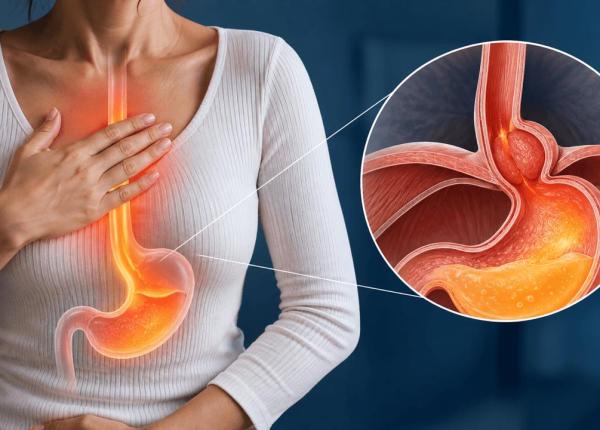hernia hiatala cand arsurile din piept pot fi tratate medicamentos si cand chirurgia devine o optiune