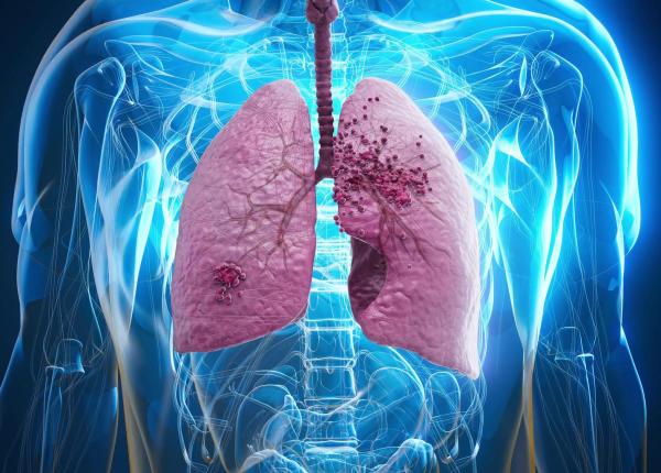 ce este mai exact un nodul pulmonar si care este legatura cu cancerul cazul papei leon
