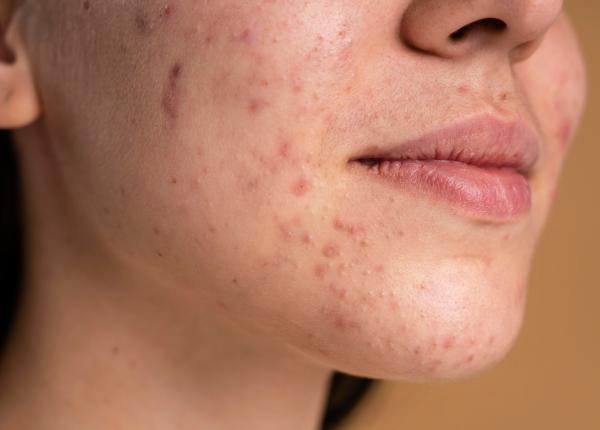 acneea tot mai raspandita la nivel mondial numarul cazurilor ar putea ajunge la 77 de milioane pana in 2050