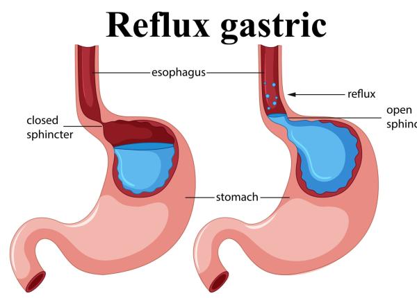 remediul cu otet care ar putea ajuta in refluxul gastric atentie insa uneori poate agrava simptomele