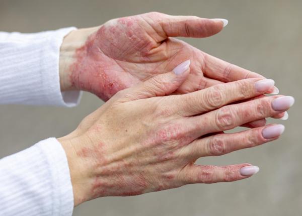 dincolo de ceea ce vezi psoriazisul nu se opreste la piele