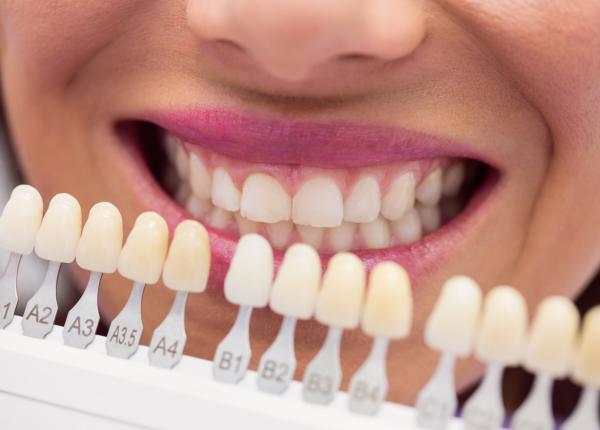 pot avea fatete dentare fara slefuirea dintilor un stomatolog explica in ce cazuri este posibil