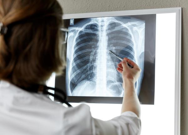 cancer pulmonar la nefumatori factori de risc si simptome