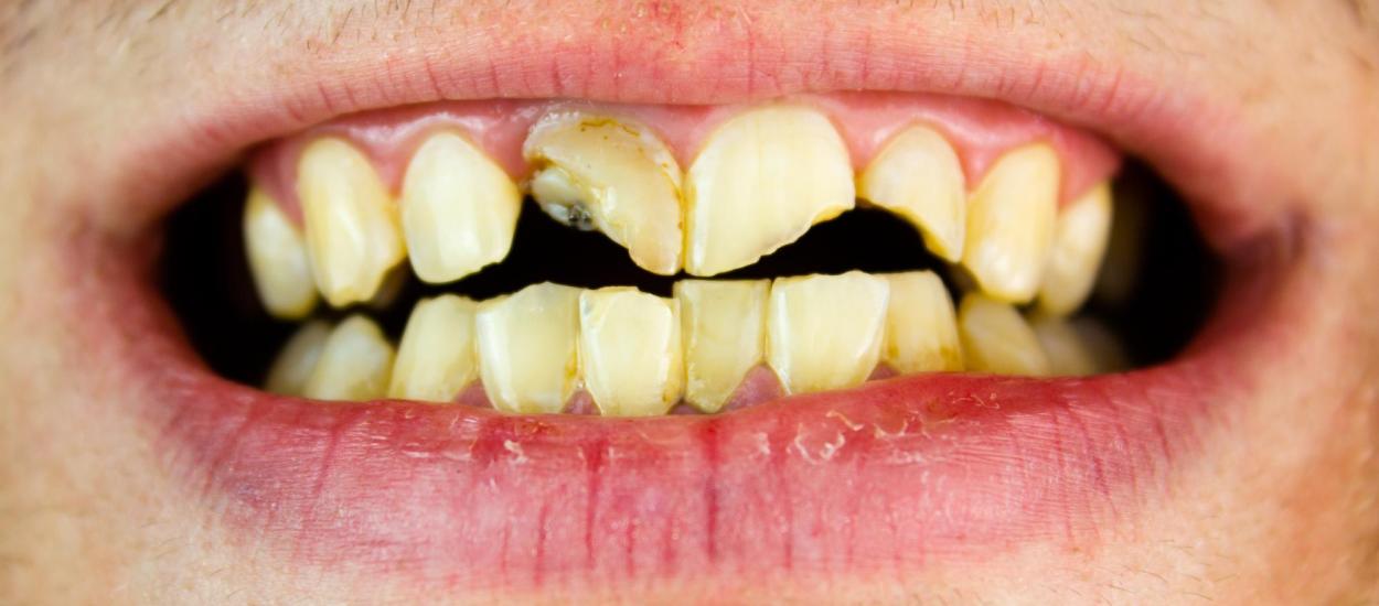 România, codașă la finanțarea stomatologiei, arată OCDE. Avertismentul CMSR: 66% dintre copii și 64% dintre adulți au carii