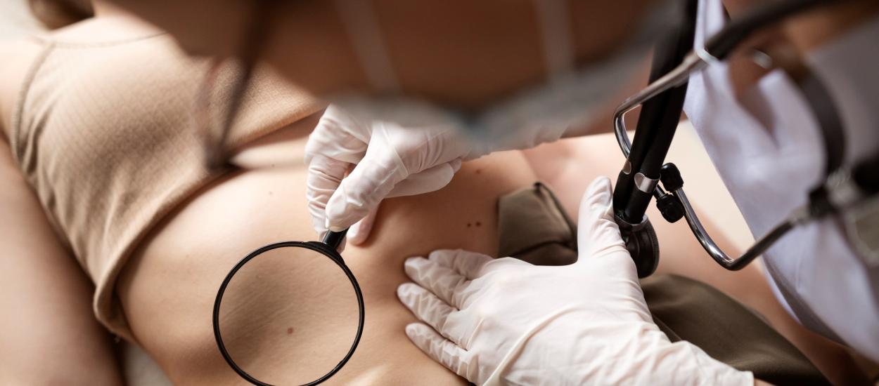 Solarul provoacă leziuni în ADN și triplează riscul de melanom: Pacienții au toată pielea afectată