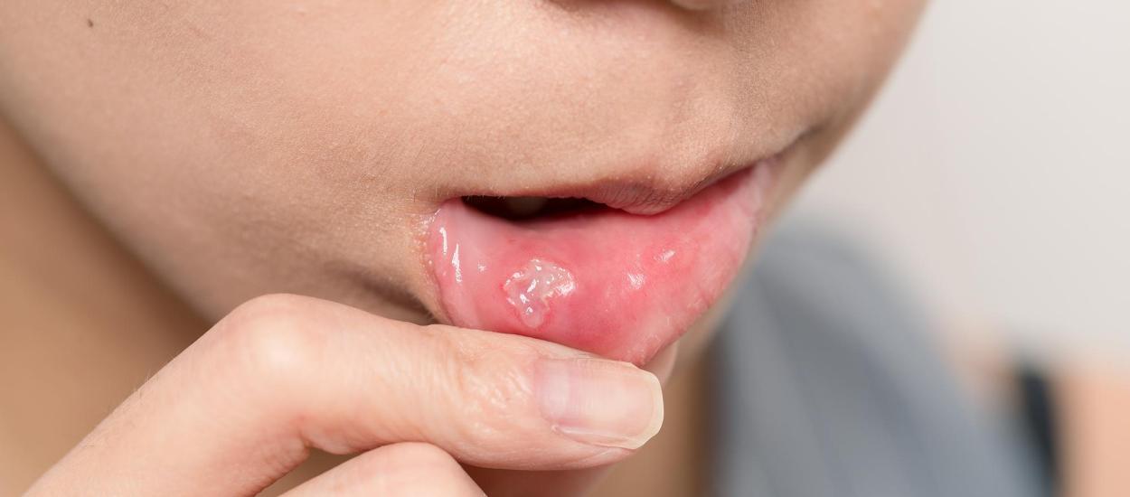 De ce faci herpes la gură