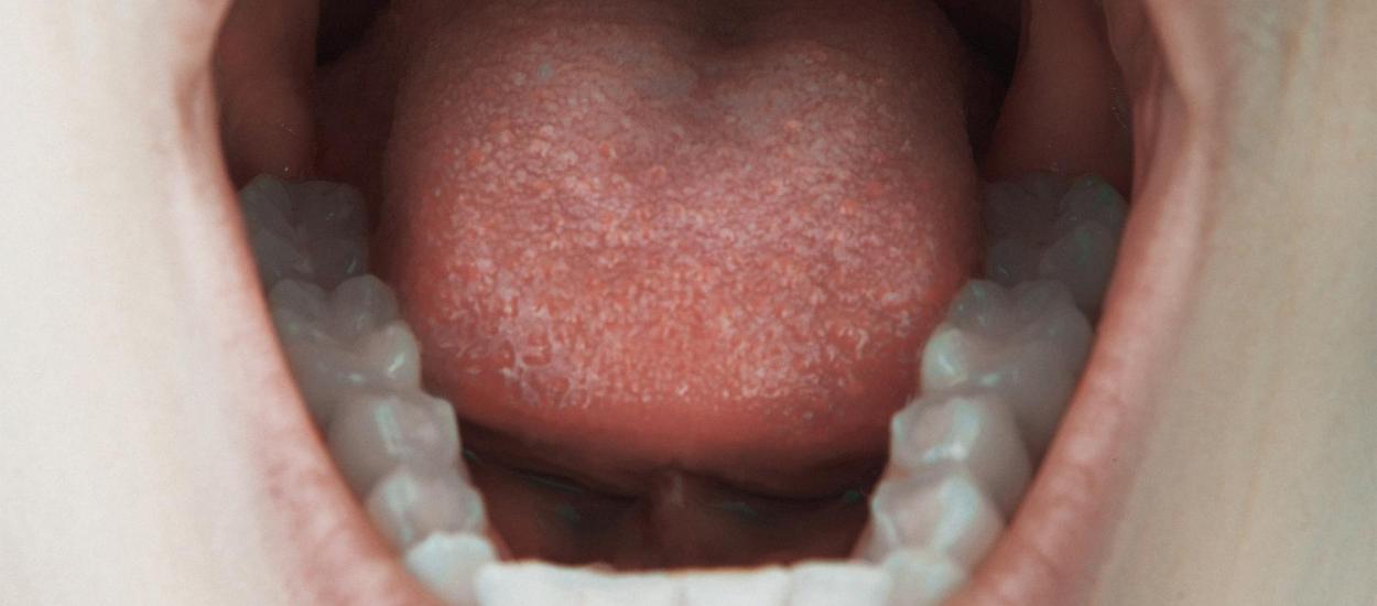 Semnalele de alarmă din gură care pot indica riscul de cancer de colon