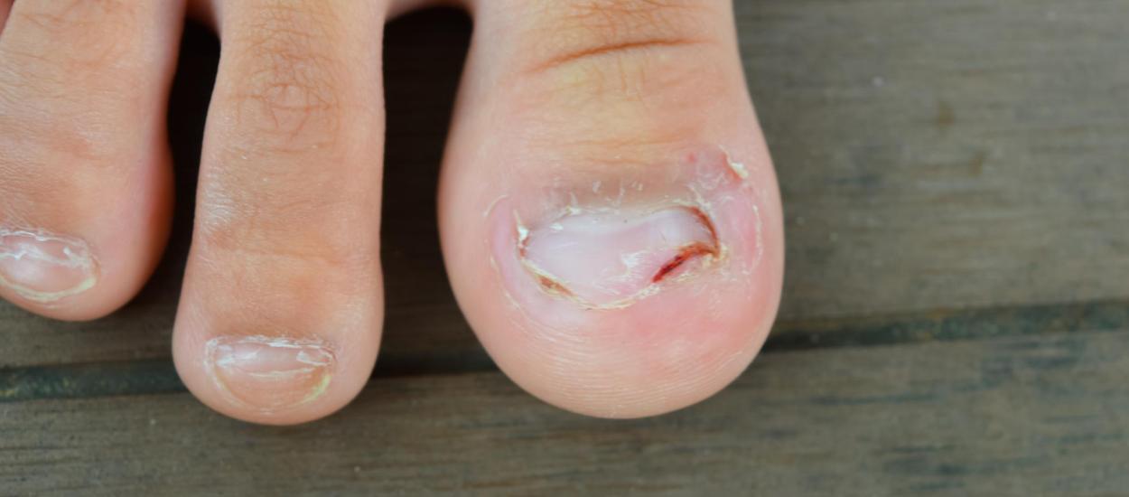 Unghiile încarnate: de ce apar?