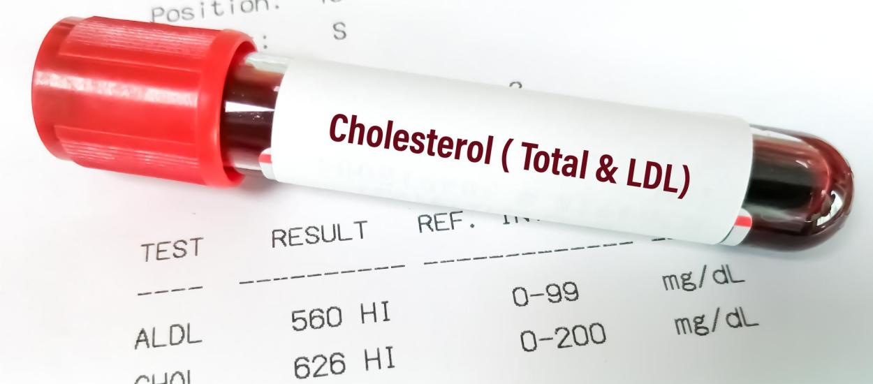 Analiza de sânge care prezice infarctul mai bine decât colesterolul mărit