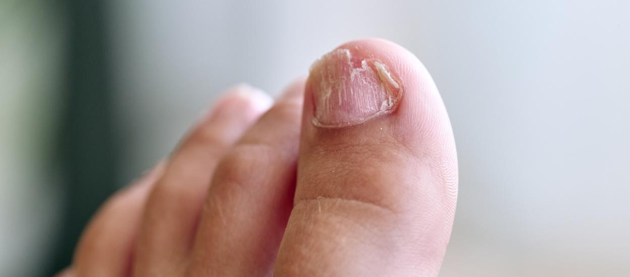 Cum să recunoști o unghie încarnată infectată