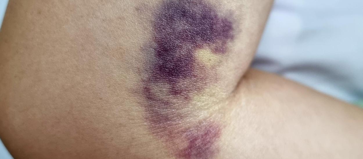 Ce înseamnă când o vânătaie este verde sau neagră. Primul semn să mergi la medic