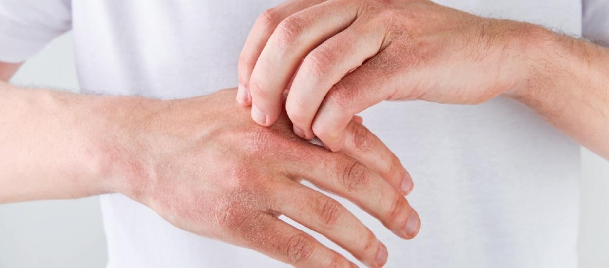 Pielea uscată și crăpată – cum contribuie ureea în susținerea barierei cutanate