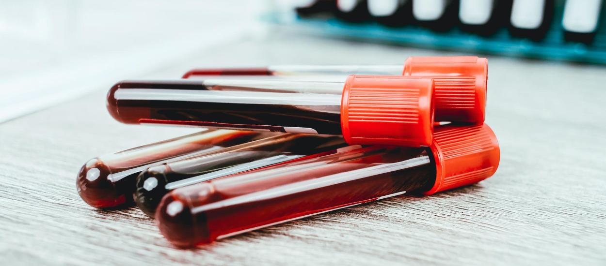 MethylScan, testul de sânge ieftin care depistează cancerul înainte de apariția simptomelor