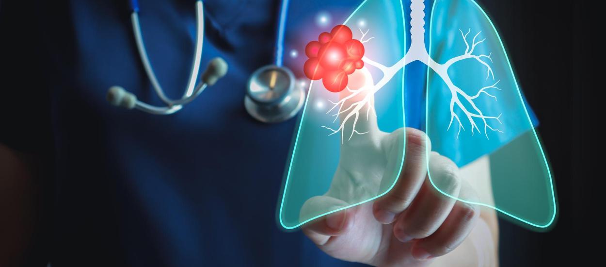 De ce crește incidența cancerului pulmonar sub 50 de ani. Care este legătura cu mâncarea