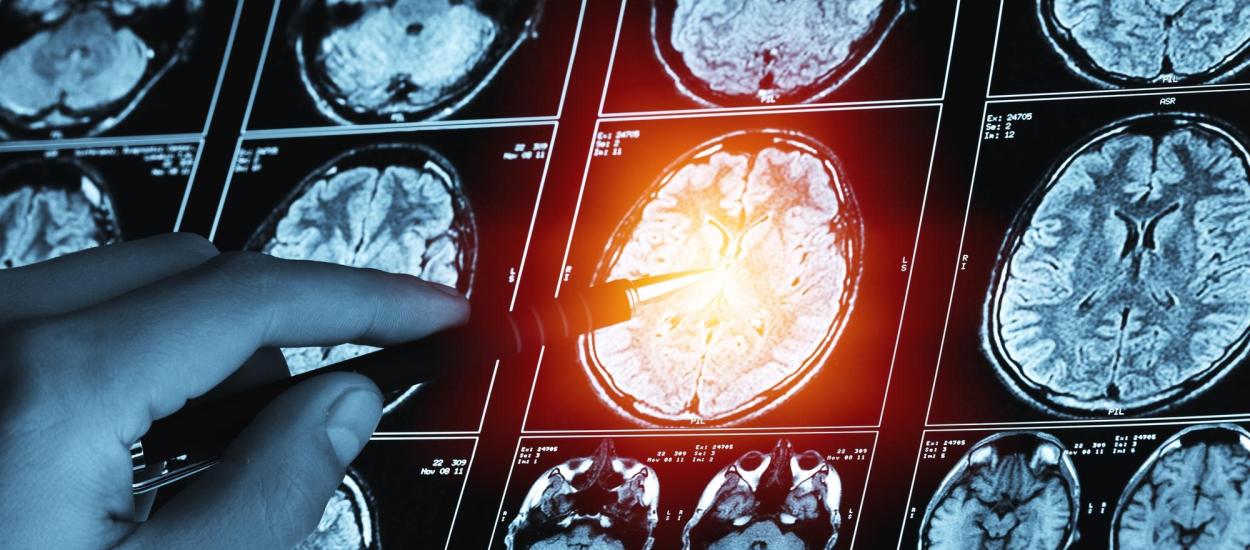 Metastazele cerebrale în cancerul de sân: ce simptome apar și când apare răspândirea la creier