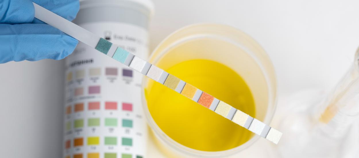 Proteine în urină, proteinuria: ce înseamnă și ce afecțiuni ascunde acest semn