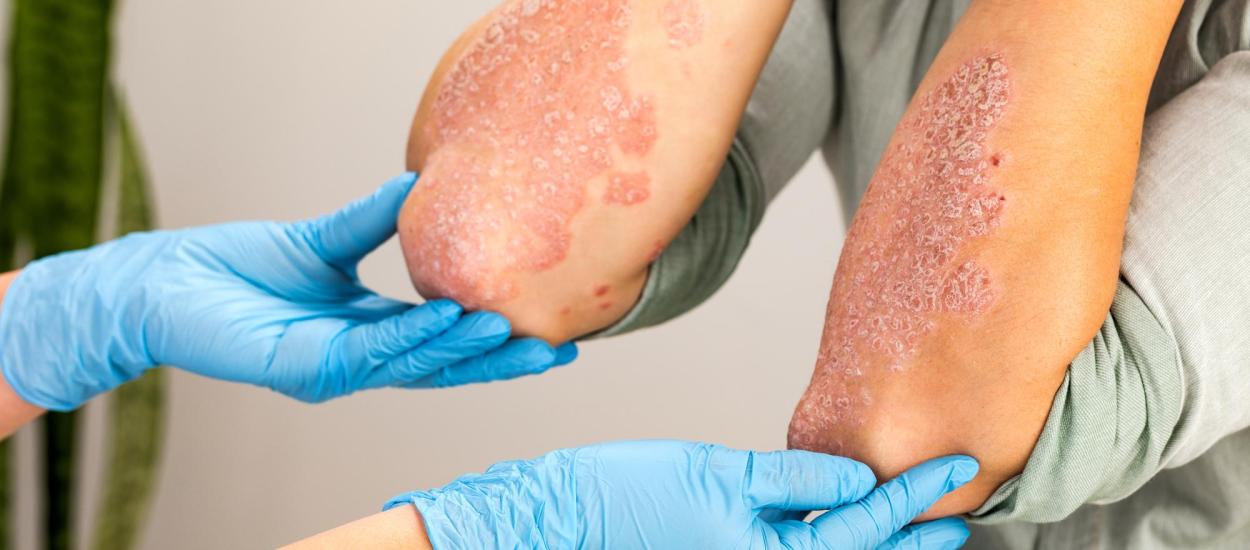Care e diferența dintre psoriazis și eczemă: de ce apar cele 2 afecțiuni