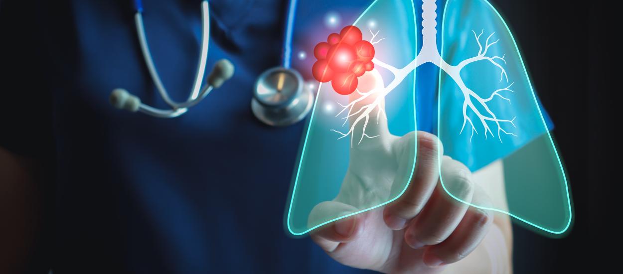 Imunoterapia postoperatorie cu Nivolumab, ineficientă în cancerul pumonar