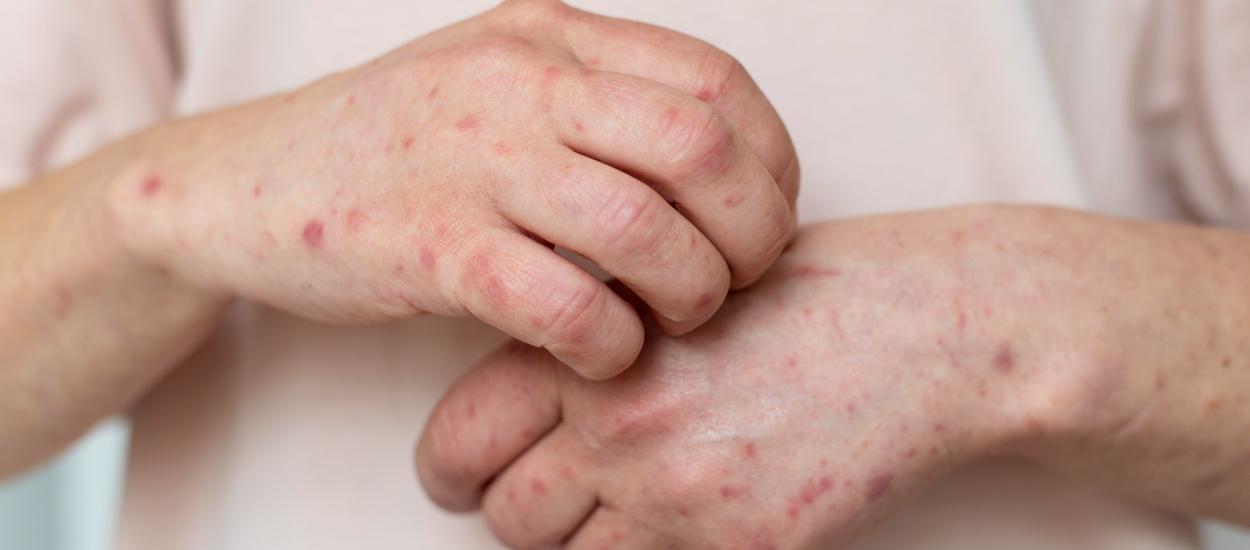 Vitamina A, folosită greșit împotriva rujeolei, a dus la creșteri masive de intoxicații