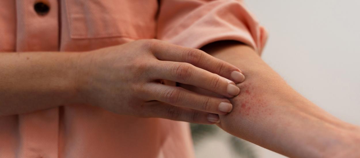 Boala de piele care îți poate dubla riscurile metabolice. Ce ascunde forma familială de hidradenită supurativă