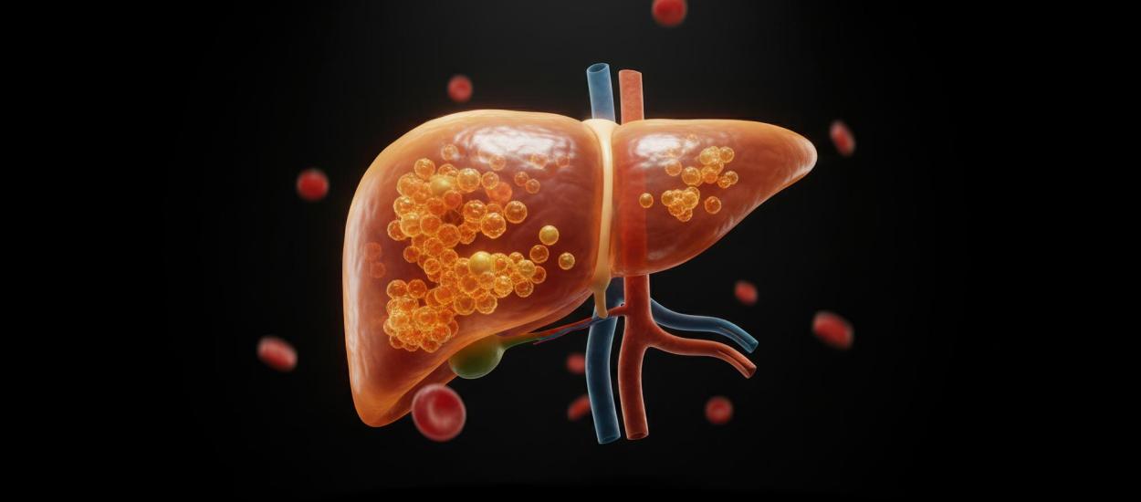 Un obicei aparent banal care îți poate afecta ficatul pe termen lung. Un singur suc acidulat pe zi crește riscul de cancer hepatic