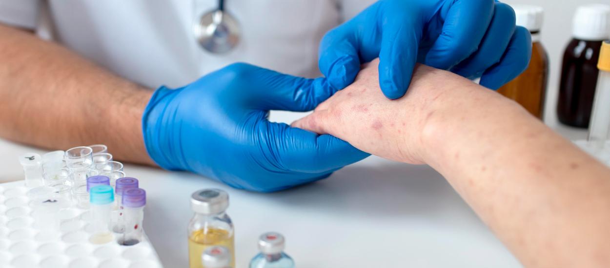 Sfârșitul lupusului? Cercetătorii au descoperit o bacterie care reduce semnificativ boala