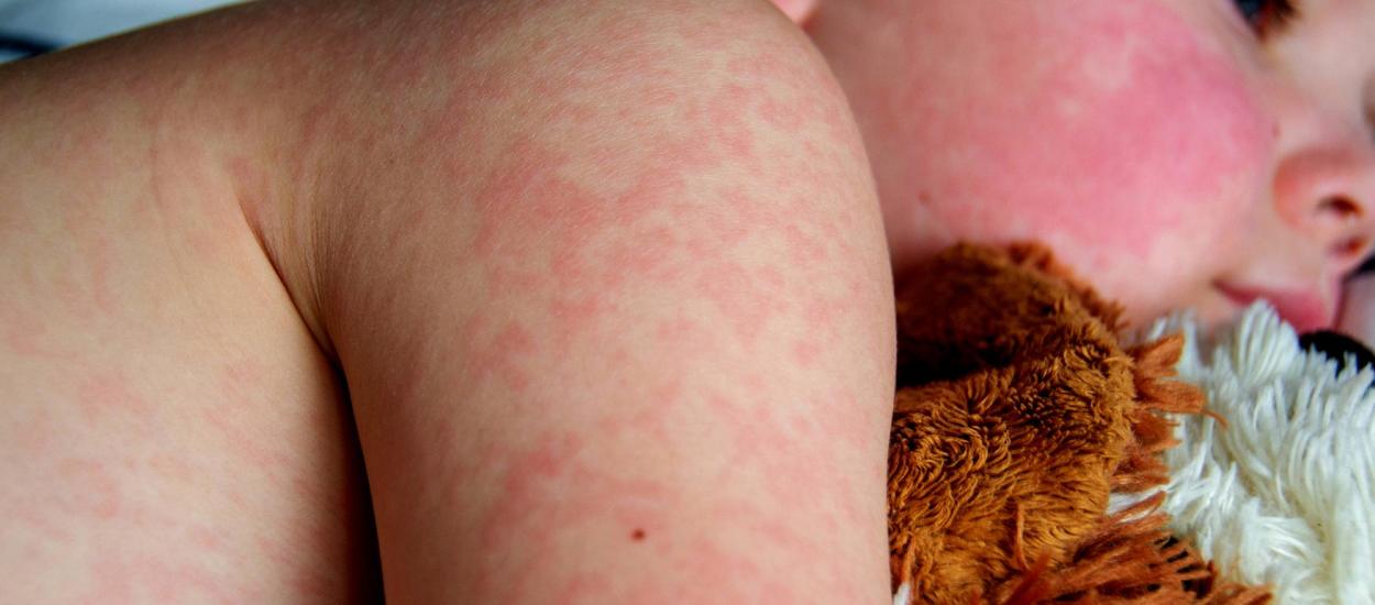 Rujeola, din nou o amenințare: vaccinarea scade, iar tratament nu există