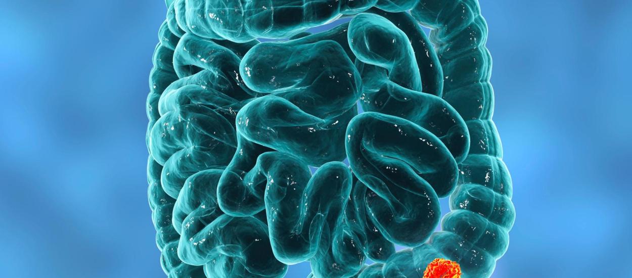 Semnele ascunse ale cancerului colorectal pe care tinerii le trec cu vederea