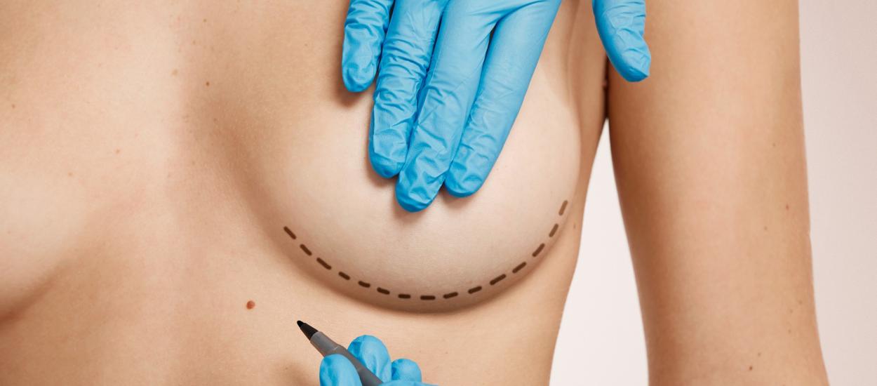 Urmează să faci o mastectomie? Sfaturi de vindecare a pielii