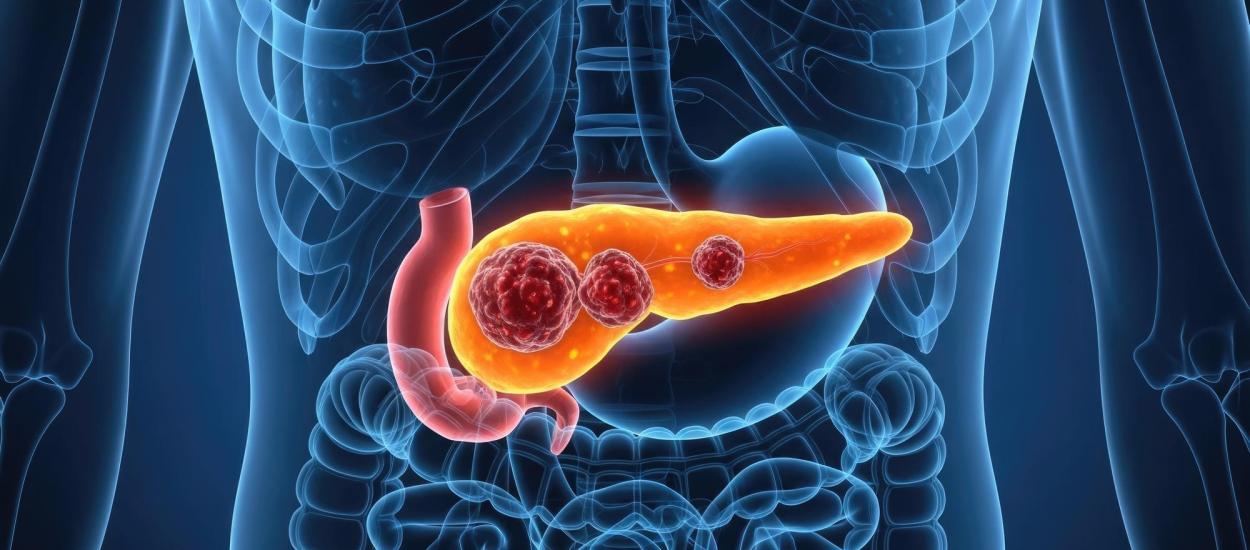 Punctul slab al cancerului pancreatic, identificat de medici