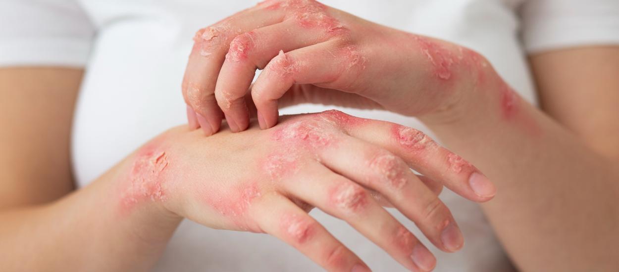 Ce alimentează, de fapt, psoriazisul? O descoperire neașteptată deschide calea unor tratamente noi