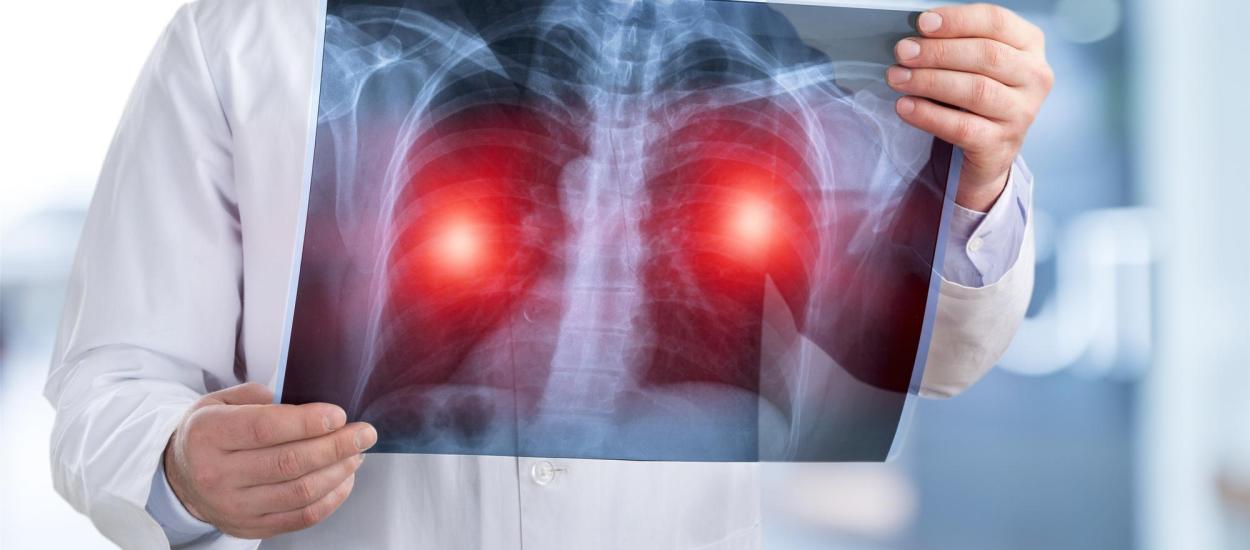 Cancerul care ucide cel mai mult în România. Testul simplu care poate salva vieți înainte să apară simptomele cancerului pulmonar