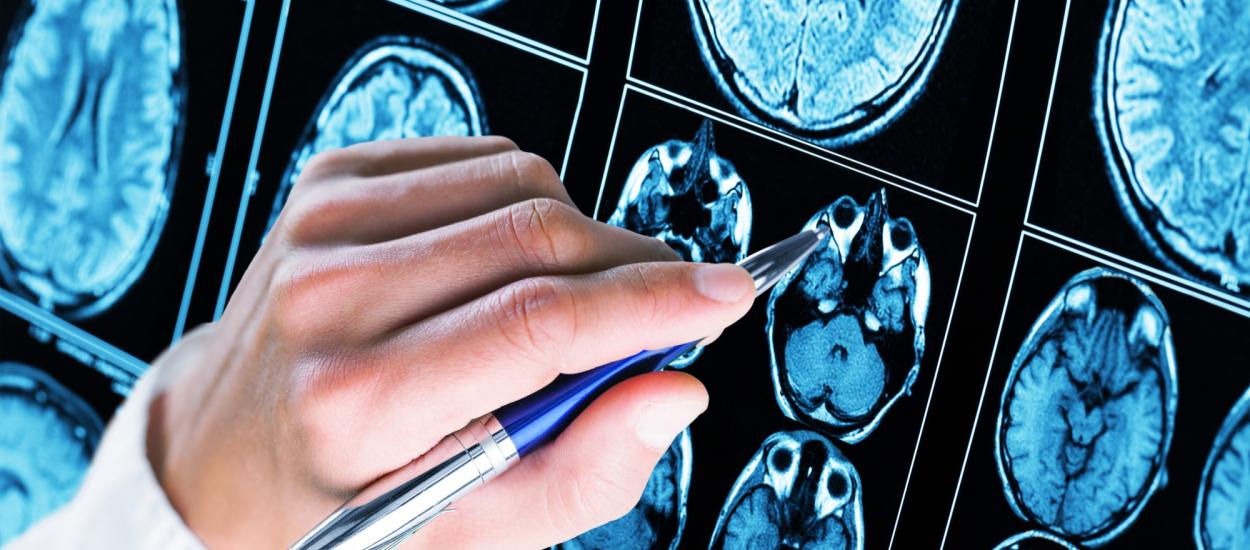 Ce au găsit cercetătorii în creierul persoanelor cu Alzheimer ar putea schimba tratamentul bolii