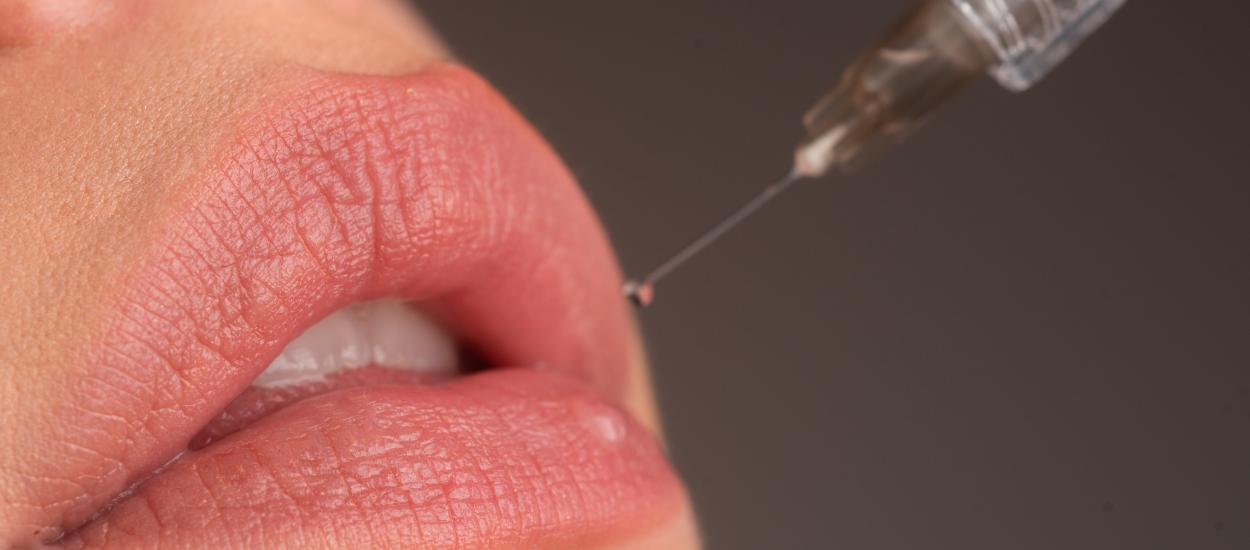 Ți-ai mărit buzele? Cele 4 greșeli care pot strica rezultatul după injectarea cu acid hialuronic