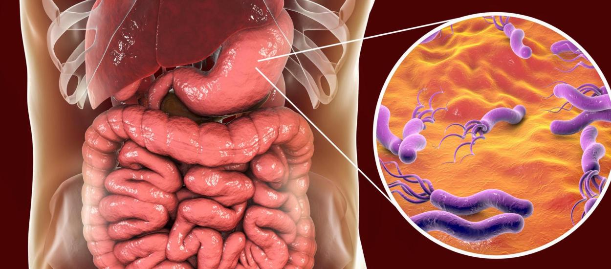 Simptomele infecției cu Helicobacter pylori. Se poate trăi cu această bacterie în stomac?
