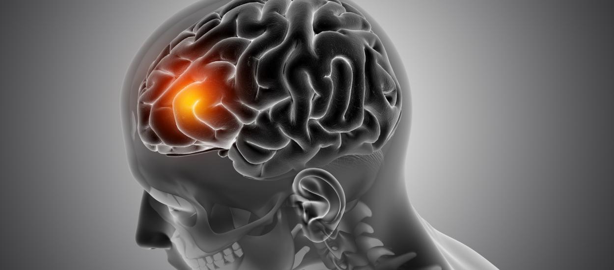 AVC-ul nu înseamnă sfârșitul drumului: ce se întâmplă în creier după un accident vascular cerebral